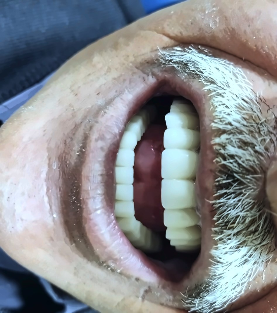 אותו מטופל אחרי: שיניים לבנות גמורות.